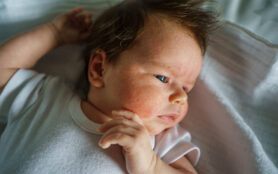 Neurodermatitis,Chronic,Constitutional,Atopic,Eczema,Small,Newborn,Baby,With,Dry